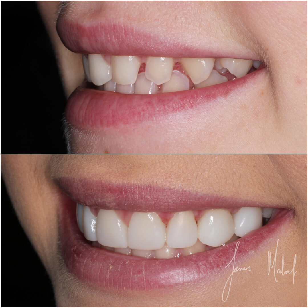 composite veneers